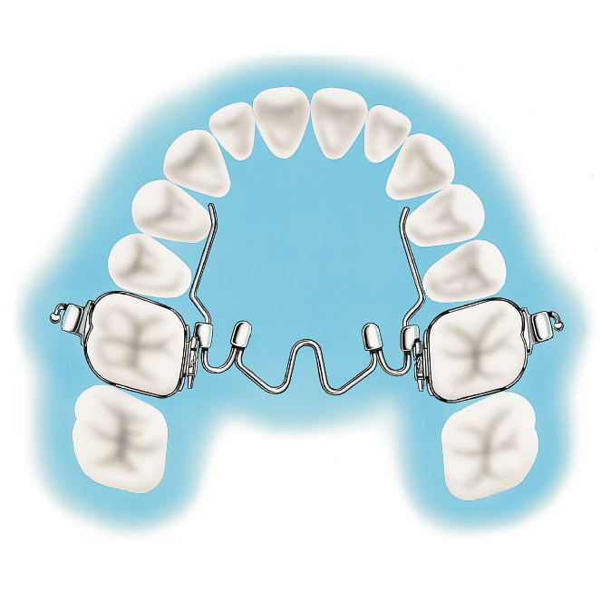 NITANIUM PALATAL EXPANDER 34MM NAOL Australia